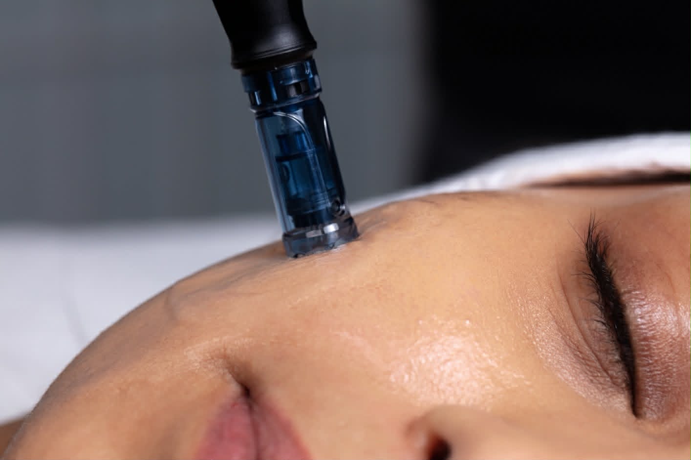Microneedling treatment close-up for skin rejuvenation in Morecambe